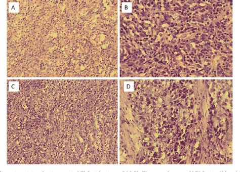 Figure From Collision Of Lymphoepithelioma Like Carcinoma With