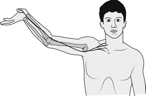 Lateral Elbow Pain With Cervical And Nerve Related Components