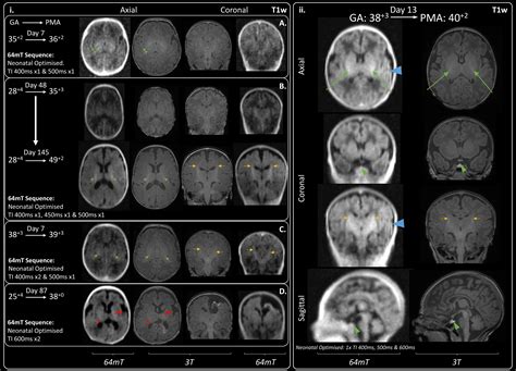 Development Of Neonatal Specific Sequences For Portable Ultralow Field Magnetic Resonance Brain