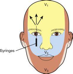 Supraorbital Nerve Block for Supraorbital Neuralgia | Musculoskeletal Key