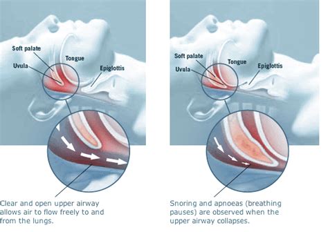 Sleep Apnea Therapy Complete Respiratory Care