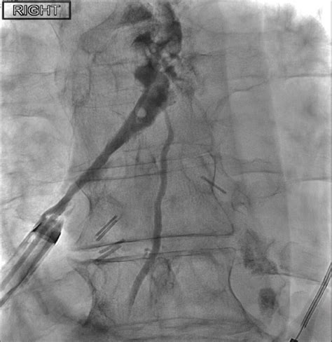 Chest Fluoroscopic Image With Contrast Outlining An Irregu Lar Cavity