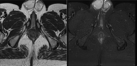 Axial Contrast Enhanced T1 Weighted Mr Image Showing Mild Residual