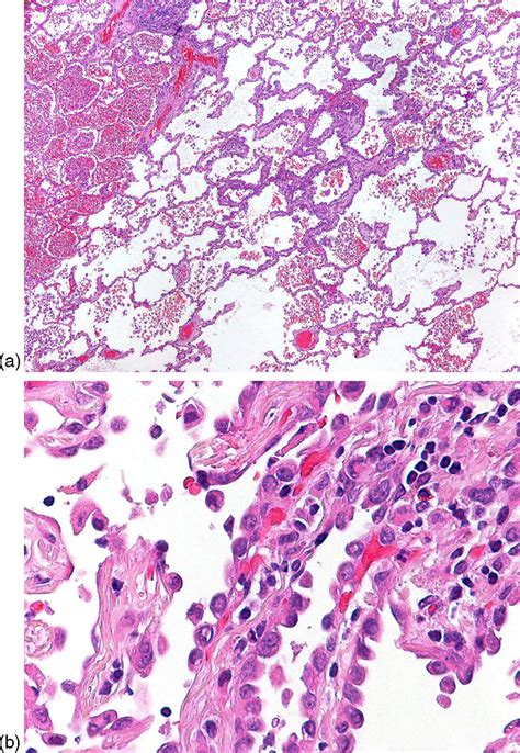 Genetic Relationship Among Atypical Adenomatous Hyperplasia Bronchioloalveolar Carcinoma And