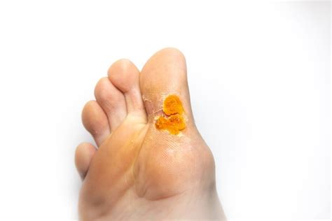 7 Home Remedies For Plantar Warts That Actually Work — Prime Foot And Ankle Specialists Voorhees