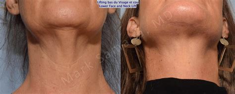 Lifting Du Visage Cou Facelift Necklift Avant Apr S Photos