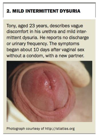 Urethritis In Men Medicine Today