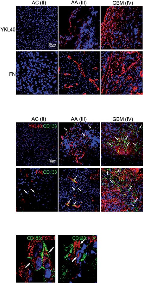 Figure From The Pgi Klf Pathway Regulates Self Renewal Of Glioma