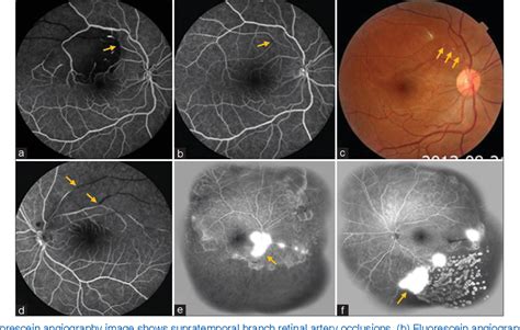 Figure 1 From Progressive Susac Syndrome With Bilateral Visual Loss And