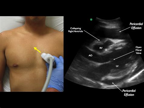 Pericardiocentesis — Highland Em Ultrasound Fueled Pain Management