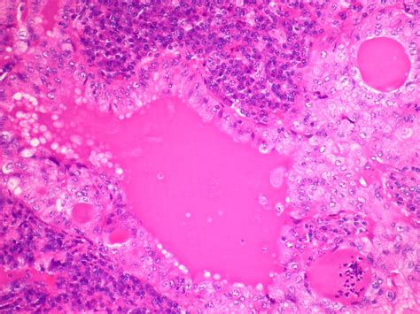 Pathology Outlines Mucoepidermoid Carcinoma