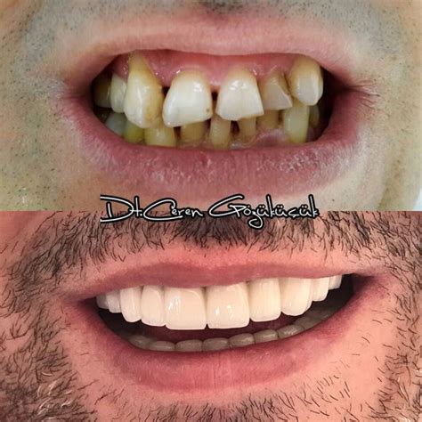 Zirkonyum Kaplama Ceren Dental Clinic