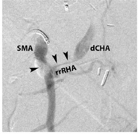 Superior mesenteric artery (SMA) arteriogram in the right oblique... | Download Scientific Diagram