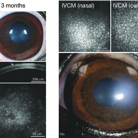 Anterior Segment Photography Fd Oct And Ivcm Imaging Of A 9 Year Old Download Scientific