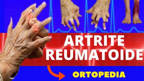 Artrite Reumatoide Curso De Saude