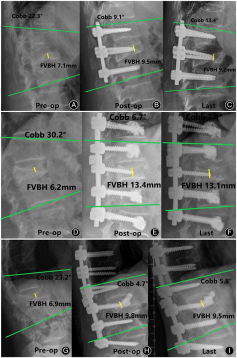 The Fig Shows The Preoperative Pre‐op Postoperative Post‐op And