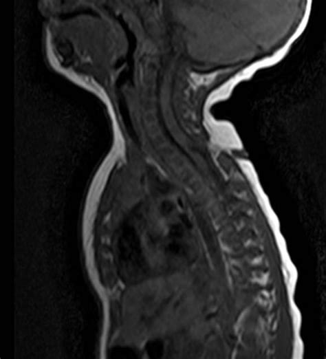 Congenital Dermal Sinus Tract Image