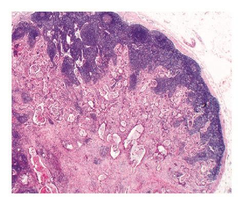 Hande Stained Sections Of Grade 2 Moderately Differentiated Download Scientific Diagram