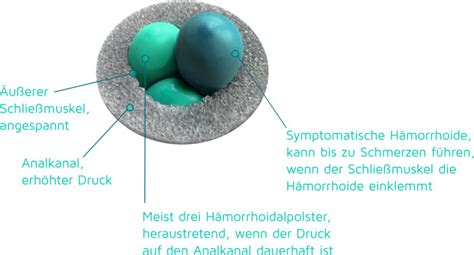 Hämorrhoiden am After was ist dann zu tun