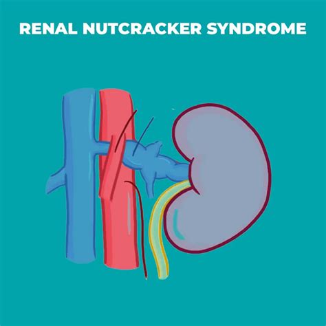 Nutcracker Syndrome: Symptoms, Risk Factors, and Treatment