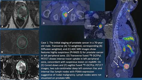 New Radiotracer Improves Management Of Prostate Cancer Patients