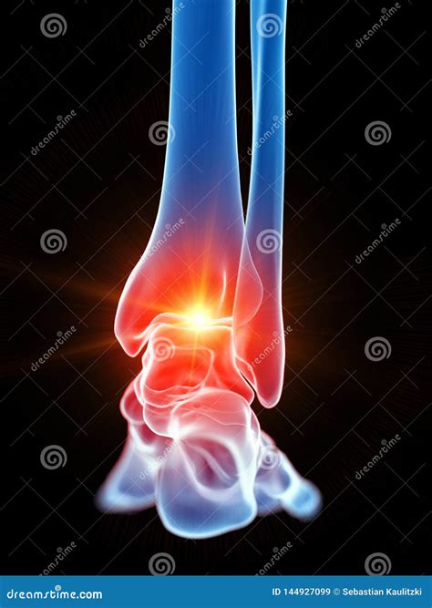 The Ankle Joint Showing Pain Stock Illustration - Illustration of