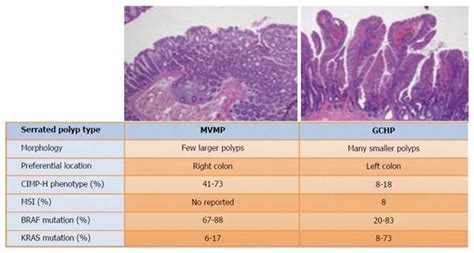 Sessile Serrated Adenoma Vs Hyperplastic Polyp