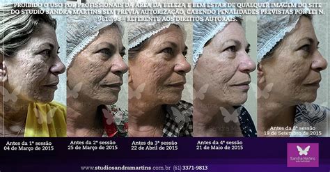 Quantas Sess Es De Microagulhamento Para Diminuir Os Furinhos De Acne