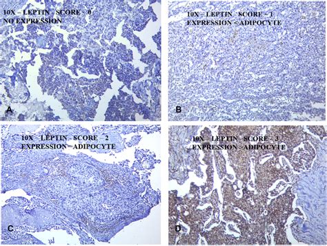 Ihc Scoring For Leptin Score 0 Negative Expression A Score 1 Download Scientific Diagram