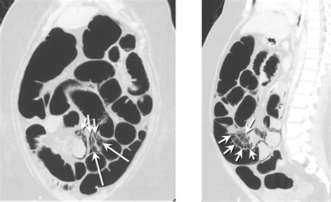 Pneumatosis Intestinalis And Intestinal Perforation In A Case Of