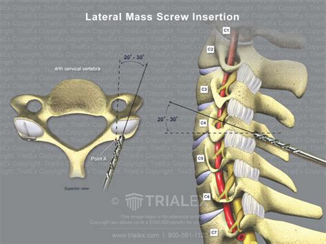 Lateral Mass Screw Insertion TrialQuest Inc