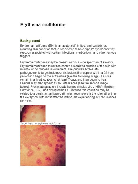 Erythema Multiforme Pdf Infection Herpes Simplex