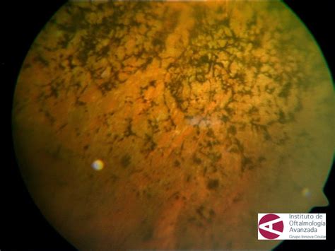 Miranza IOA RETINOSIS PIGMENTARIA