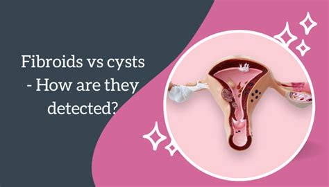 Fibroids Vs Cysts How Are They Detected Dr Mustafa Aldam