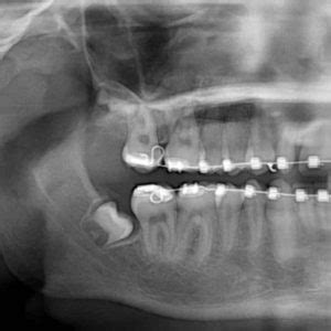 Estrazioni Dei Denti Del Giudizio Buoni Motivi Per Farle Sanitas Care