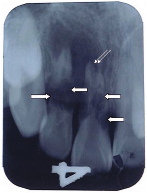 Periapical Radiograph Of Replanted Upper Left Maxillary Central And