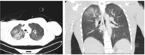 ZAP! Unexpected Electrical Injury: A Case Report EMRA