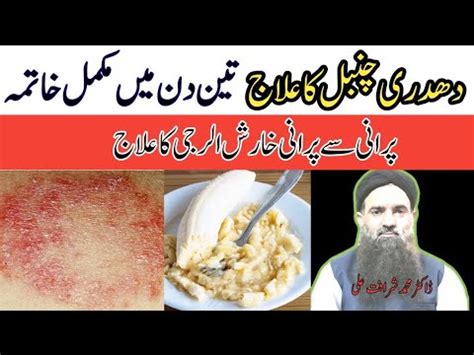 How To Remove Fungal Infection Urdu Hindi Daad Dadri Ka Ilaj