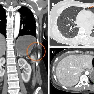 Follow Up Computed Tomography Scan On Rd Postoperative Day A And B