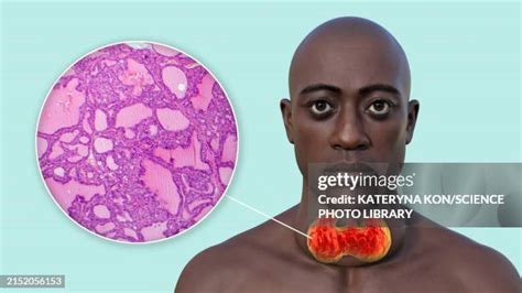 119 Thyroid Gland Histology Stock Photos, High-Res Pictures, and Images - Getty Images