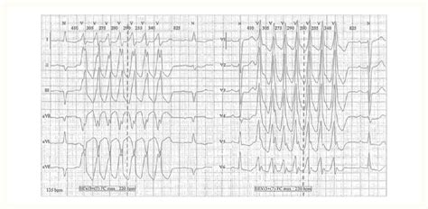 Case 1 Non Sustained Ventricular Tachycardia Recorded With Holter Download Scientific Diagram