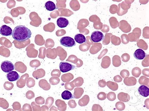 Chronic Lymphocytic Leukemia Cells