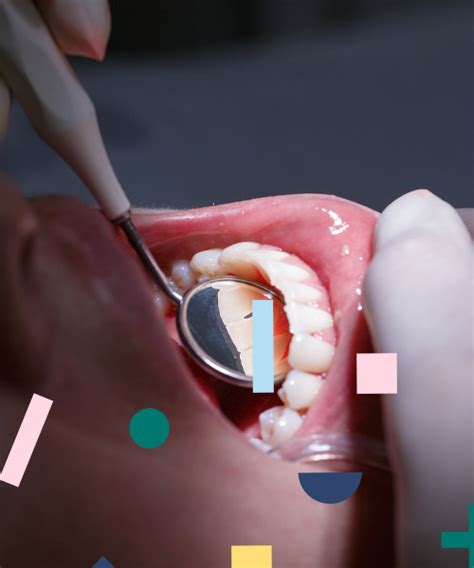 Um Guia Para A Prevenção E Tratamento De Cáries Dentárias