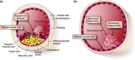 Anticoagulants For Secondary Prevention After Acute Myocardial