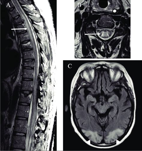 A And B Mri In T2 Fse Sequence Show Abnormal Hyperintense Signal Of