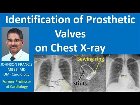 Tilting Disc Mitral Prosthetic Valve On X Ray Chest Pa View All About