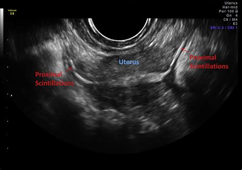 Current Methods Of Tubal Patency Assessment Fertility And Sterility