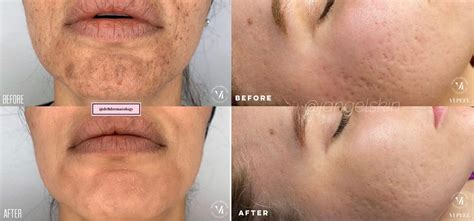 Vi Chemical Peel Allure Laser Medispa