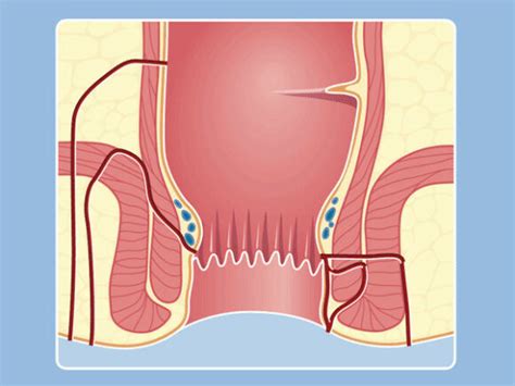 Anal fistulas ZweiChirurgen Basel Zürich Liestal