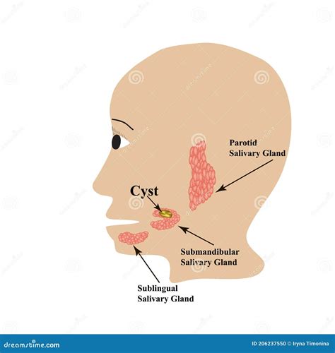 A Tumor On The Parotid Salivary Gland. Cartoon Vector | CartoonDealer ...